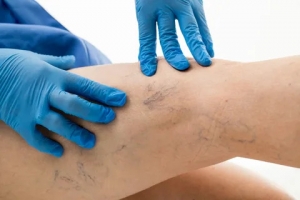 Tips to Prevent Spider Veins: A Comprehensive Guide